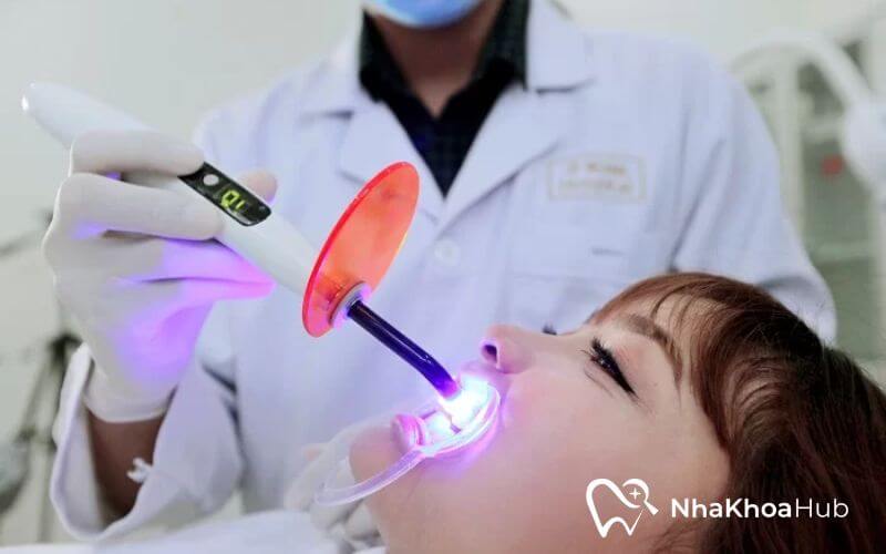 Chiếu laser làm cho keo nhanh khô và tăng độ bền cho viên đá