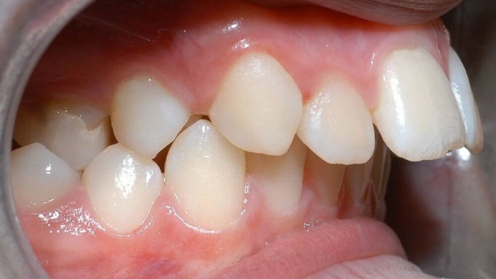 Tướng phụ nữ răng hô thể hiện nhiều về dấu hiệu xấu về vận mệnh