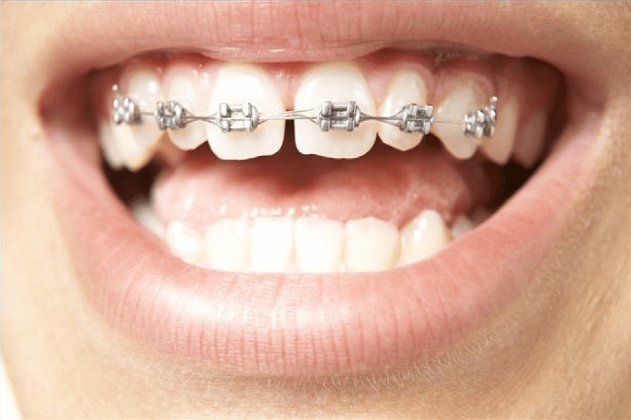 Niềng răng có hiệu quả lâu dài, bảo tồn răng thật hoàn toàn, nhưng thời gian điều trị 2-3 năm