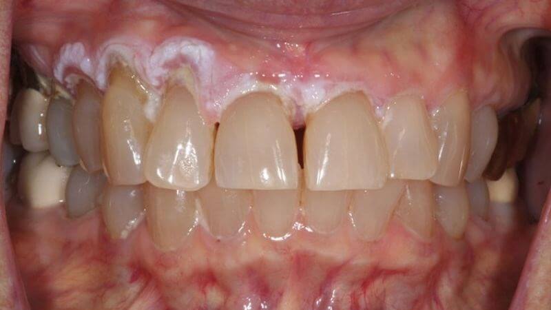 Răng cửa thưa dễ dẫn đến các bệnh về nướu