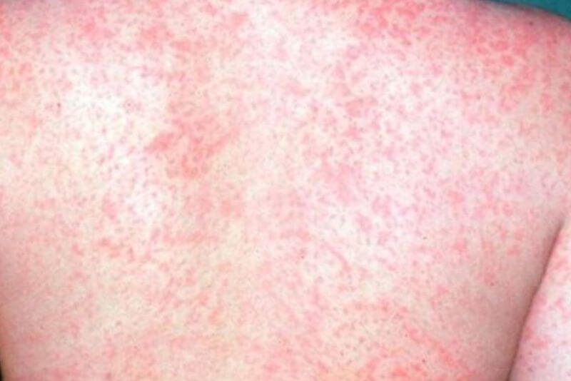 Sởi cũng là nguyên nhân gây viêm xương hàm