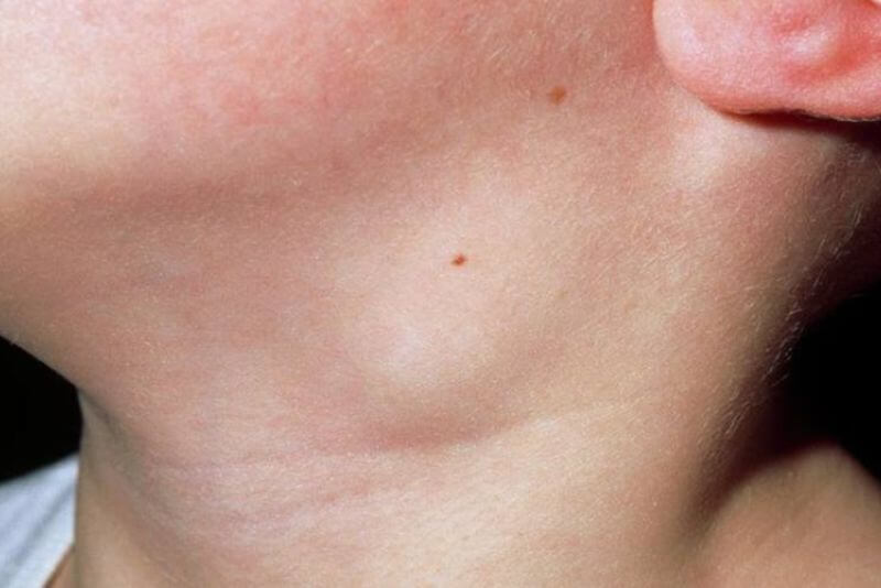 Hạch sưng do viêm răng cần được can thiệp sớm