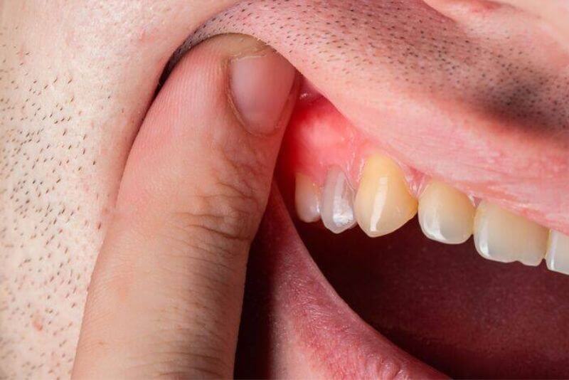 Viêm quanh răng cần can thiệp sớm