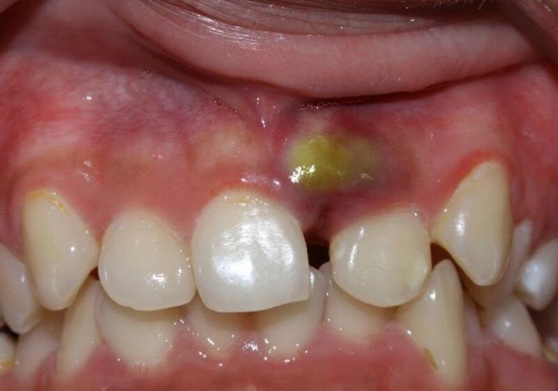 Bị áp xe ở đầu chân răng là tình trạng phổ biến 
