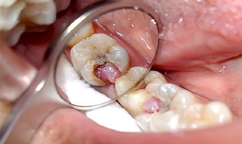 Viêm tủy nếu không điều trị dứt điểm sẽ để lại hậu quả nghiêm trọng
