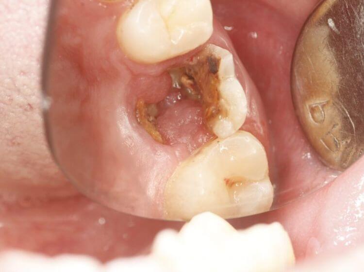 Răng bị vỡ hoặc nứt khiến người bệnh hoại tử tủy răng