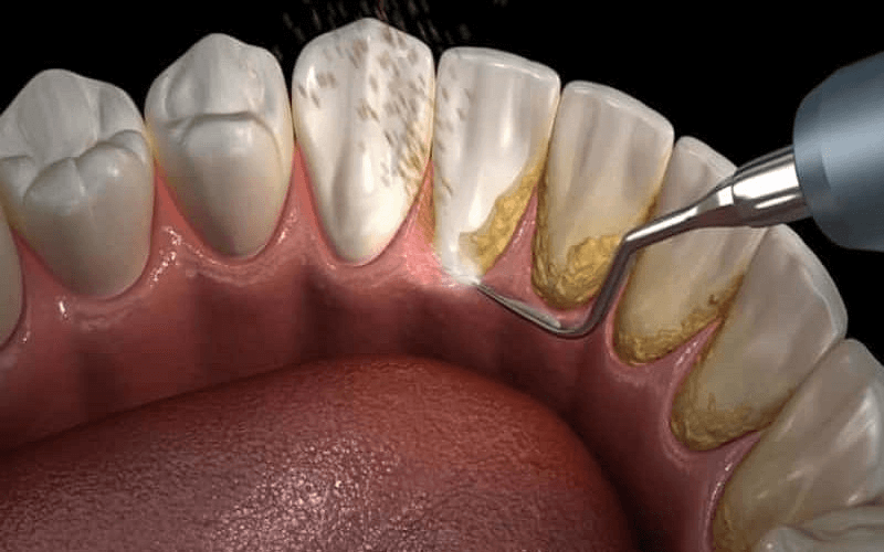 Lấy cao răng giúp ngăn ngừa các bệnh lý liên quan đến khoang miệng