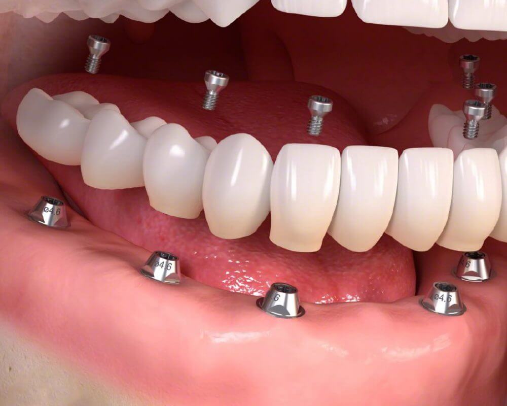 Trồng răng Implant là giải pháp phục hồi răng mất hiện đại và tối ưu