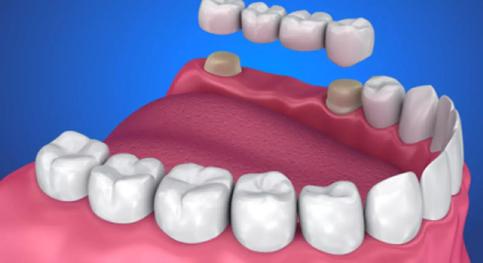 Trồng răng cầu sứ có mức giá hợp lý với nhiều khách hàng