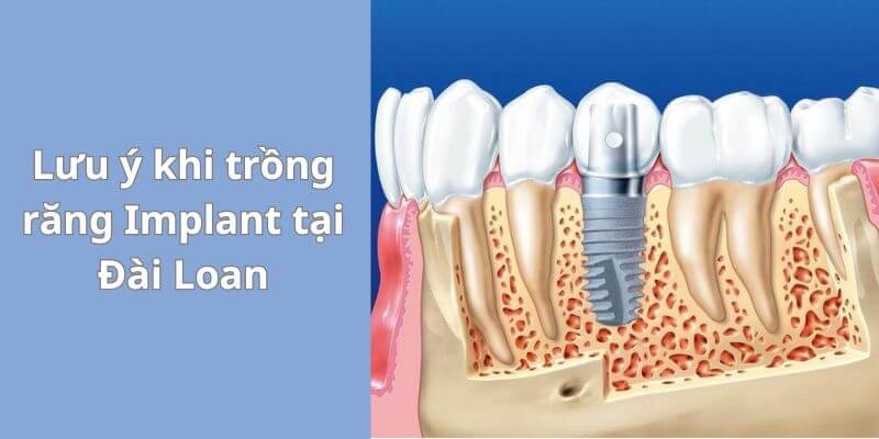 Lưu ý khi quyết định trồng răng Implant tại Đài Loan