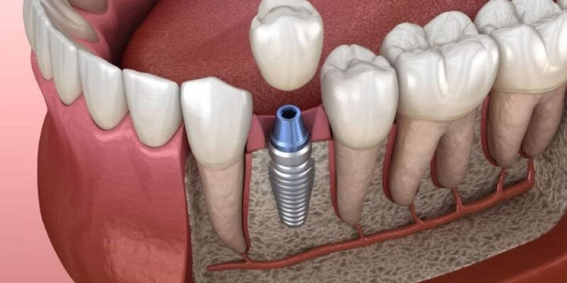 Khi trụ Implant đã tích hợp chắc chắn vào xương hàm