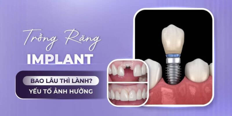 Các yếu tố ảnh hưởng đến thời gian ăn uống sau cấy Implant
