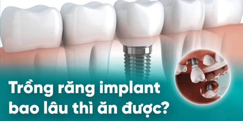Trồng răng Implant bao lâu thì ăn được?