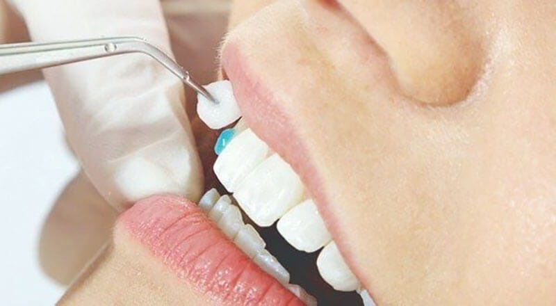 Tháo mão sứ cũ và thay mão sứ mới ôm khít để ngăn vi khuẩn tấn công