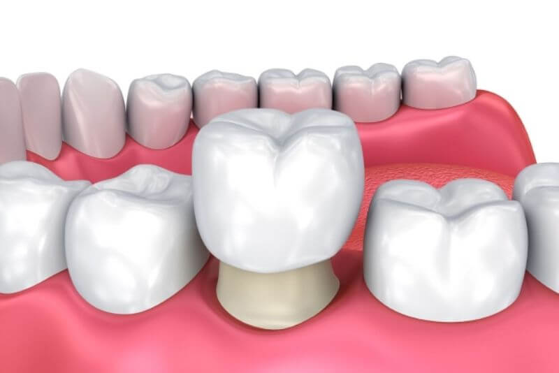 Bọc lại mão sứ chuẩn tỷ lệ, ôm khít chân răng