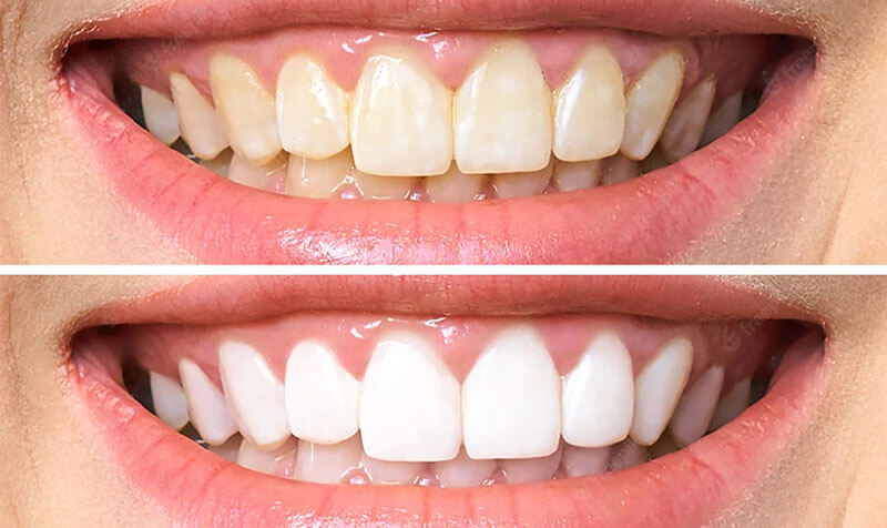 Dùng nước súc miệng và chanh tẩy vết ố trên bề mặt răng bị vàng