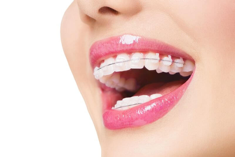 Niềng răng giúp gì? Hỗ trợ răng về đúng vị trí trên cung hàm