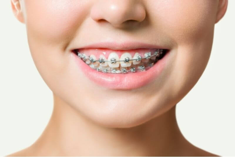 Tác dụng của niềng răng cải thiện cả về chức năng và thẩm mỹ