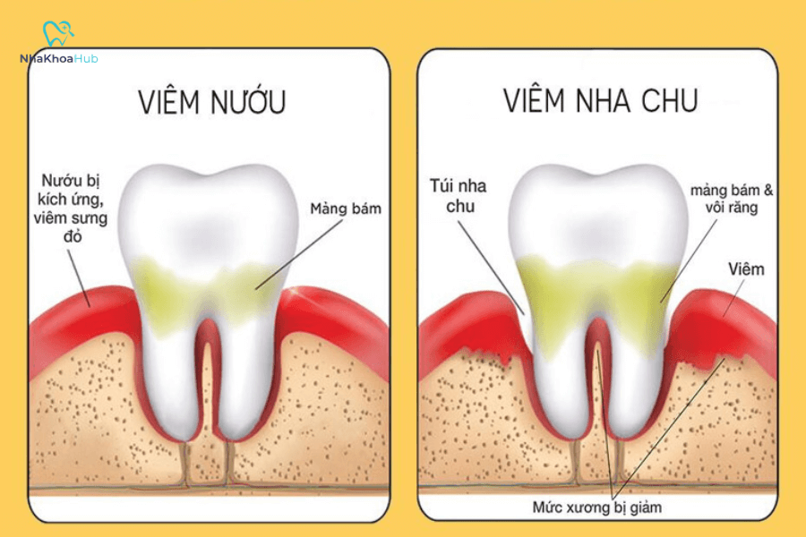 Viêm nướu và bệnh nha chu là hai bệnh lý răng miệng phổ biến