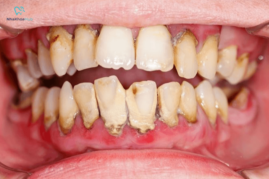 Đây là tình trạng viêm nhiễm nghiêm trọng làm tổn thương mô nướu và xương nâng đỡ răng