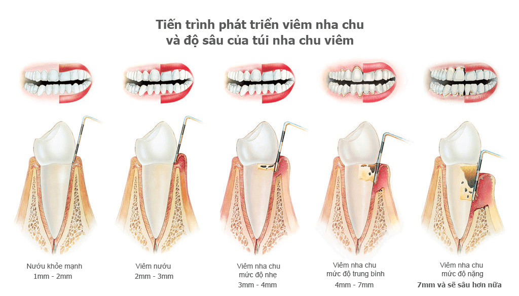 Viêm nha chu sẽ tiến triển nặng dần cho tới khi biểu hiện nghiêm trọng cần phẫu thuật