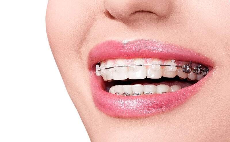 Niềng răng ở Long Xuyên đang nhận được sự quan tâm từ người dân địa phương khi nhu cầu cải thiện khớp cắn và thẩm mỹ nụ cười ngày càng gia tăng