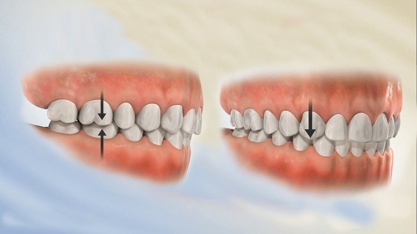 Người bệnh cần được kiểm tra các yếu tố như mức độ lệch khớp cắn, tình trạng sâu răng, viêm nướu hoặc các bệnh lý nha chu đi kèm