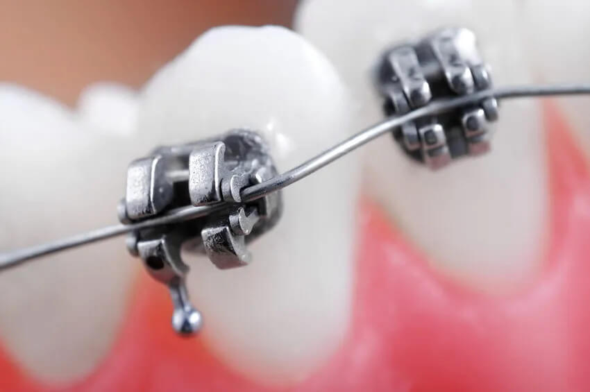 Niềng răng mắc cài tự buộc sử dụng hệ thống mắc cài cải tiến với cơ chế khóa tự động (thường là nắp trượt hoặc cánh kim loại)