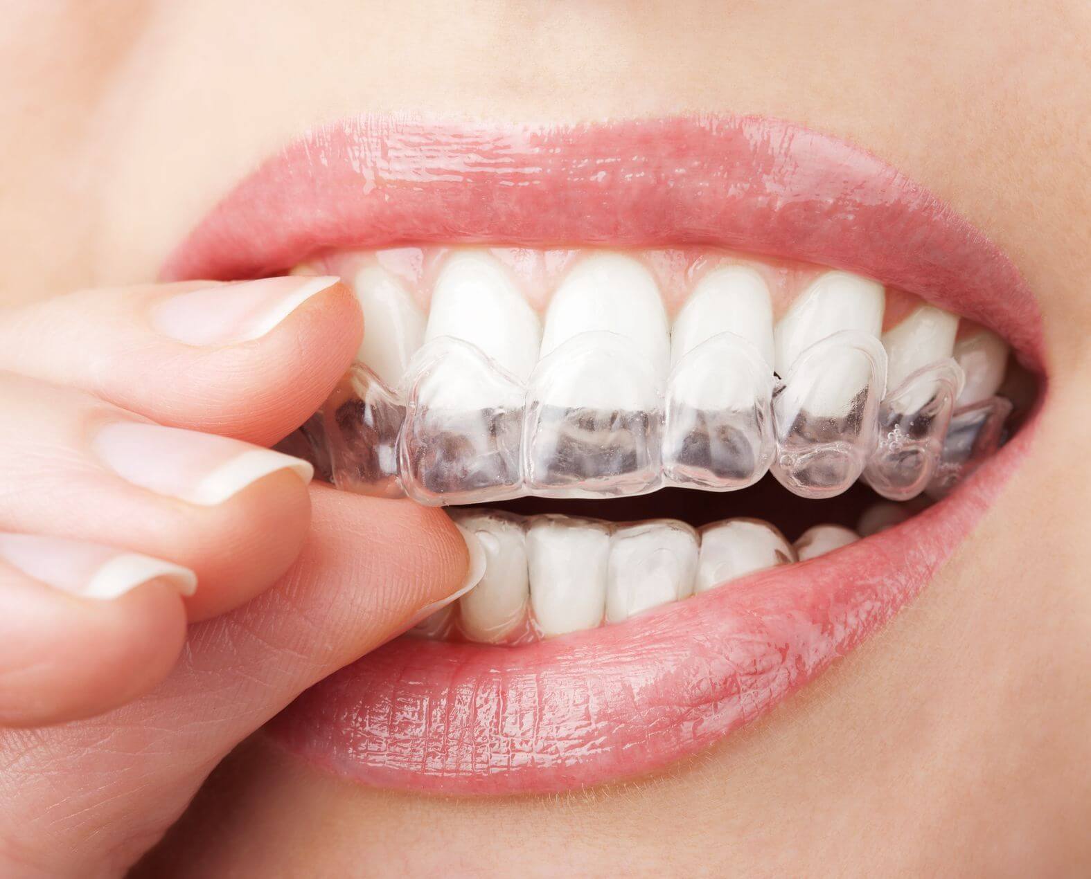 Niềng răng trong suốt được thực hiện bằng việc lắp chuỗi khay niềng bằng nhựa y khoa trong suốt, được thiết kế riêng theo cấu trúc răng của bệnh nhân 