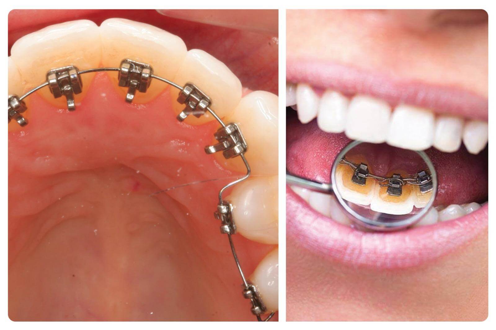 Niềng răng mắc cài mặt trong là kỹ thuật chỉnh nha có hệ thống mắc cài và dây cung được gắn hoàn toàn vào mặt trong (mặt lưỡi) của răng