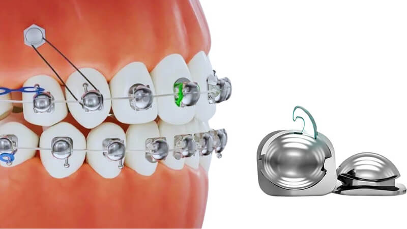 Niềng răng cánh cam ứng dụng thiết kế mới với phần đế mắc cài có hình dáng tương tự cánh cam, bo tròn cạnh, giúp hạn chế tối đa cảm giác cộm vướng khi sử dụng