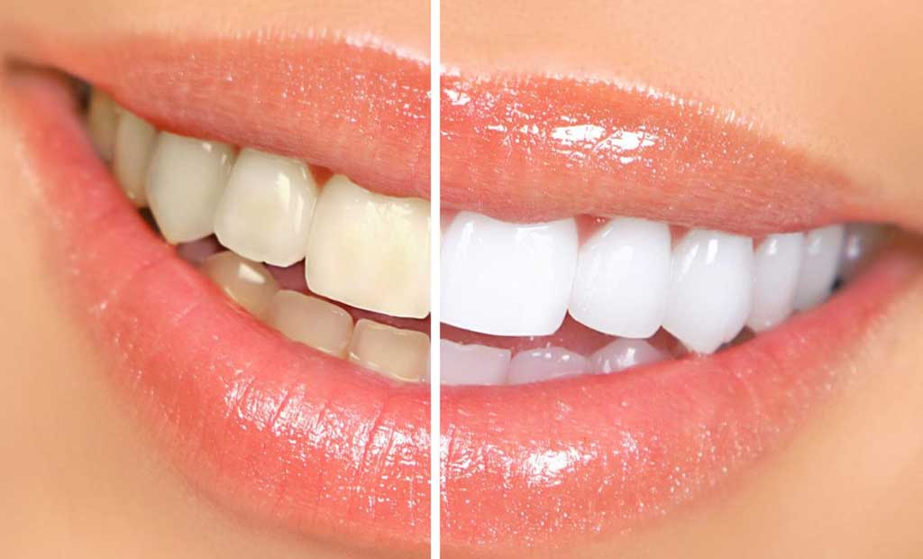 Tẩy trắng răng không chỉ là một lựa chọn làm đẹp mà còn liên quan đến các yếu tố sức khỏe răng miệng, chỉ định lâm sàng và mức độ an toàn của từng phương pháp