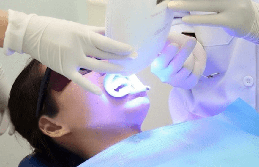 Tẩy trắng răng tại phòng khám sử dụng thuốc có nồng độ hoạt chất cao kết hợp với năng lượng ánh sáng cường độ mạnh như đèn Plasma, Laser hoặc Halogen