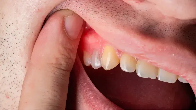 Tác dụng phụ khác thường gặp là viêm nướu do thuốc tẩy trắng tiếp xúc trực tiếp hoặc lan rộng vào các mô mềm quanh răng