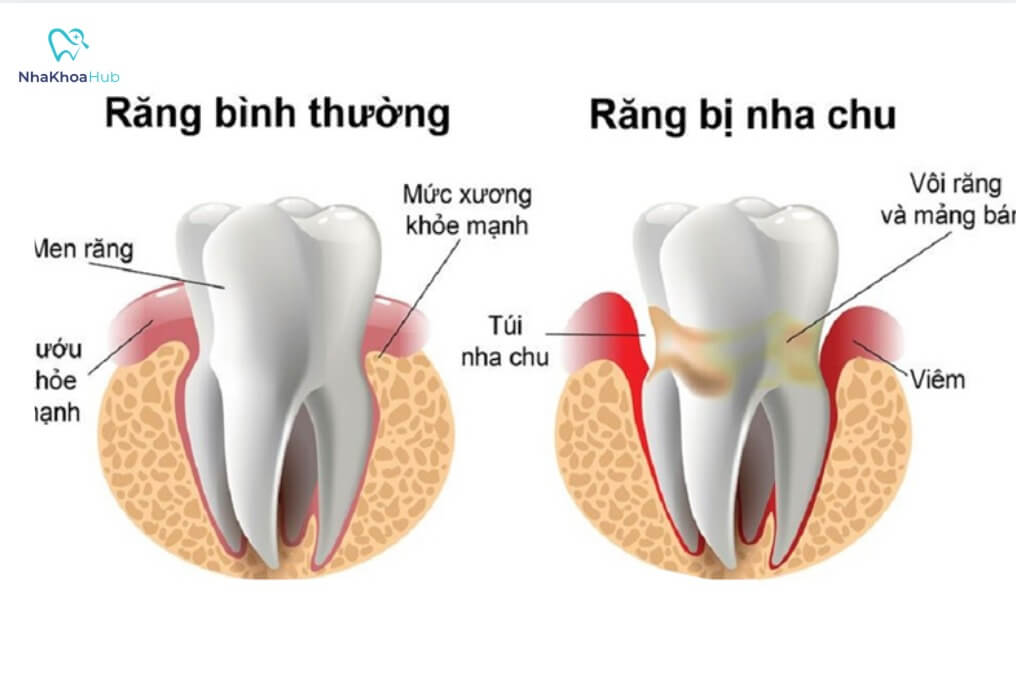 Bệnh nếu không được điều trị đúng cách có thể dẫn tới mất răng