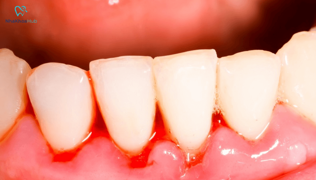 Chữa viêm nha chu trong dân gian là một trong những giải pháp tự nhiên được nhiều người tin dùng