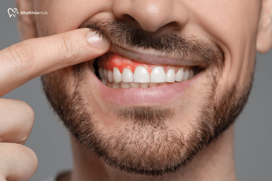 Nướu bị viêm và sưng tấy là dấu hiệu của các bệnh lý nha chu hoặc viêm nướu