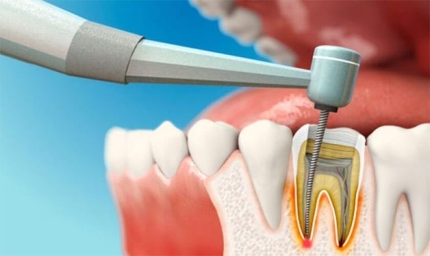 Thuốc trắng răng được đưa vào buồng tủy để cải thiện màu thật của răng