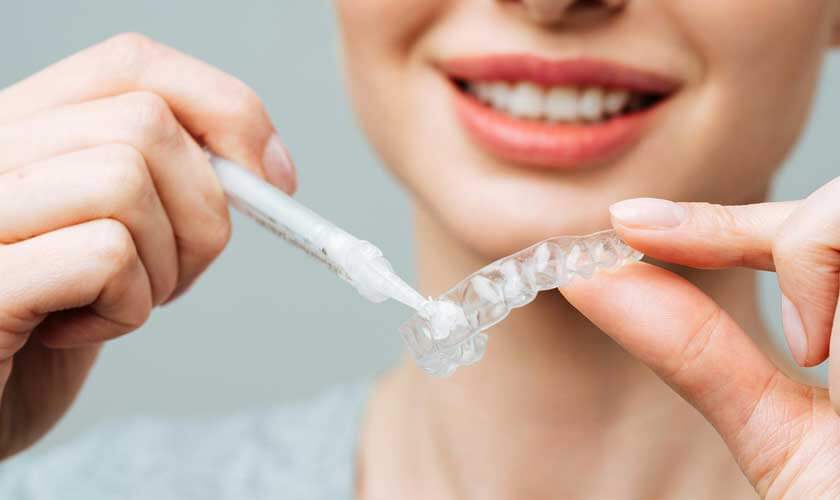 Máng nhựa đựng chất làm trắng cho người dùng đeo lên răng mỗi ngày để làm trắng dần
