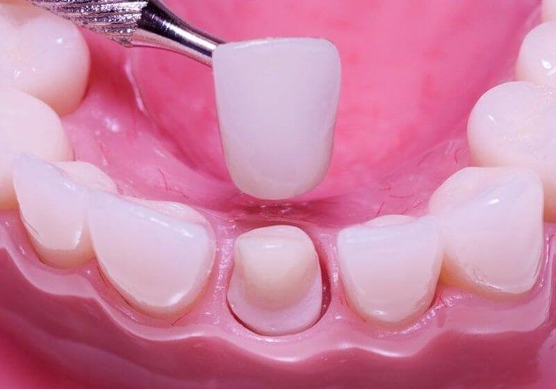 Quy trình bọc sứ yêu cầu thực hiện tỉ mỉ và chính xác
