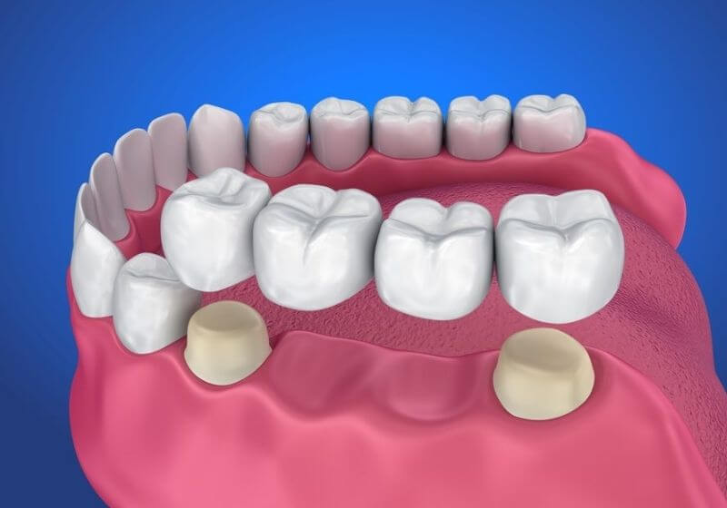 Làm cầu răng sứ dùng một dãy mão sứ gắn cố định lên hai răng thật