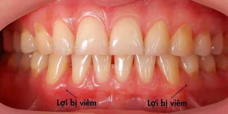 Viêm lợi khiến mao mạch ở nướu sưng tấy