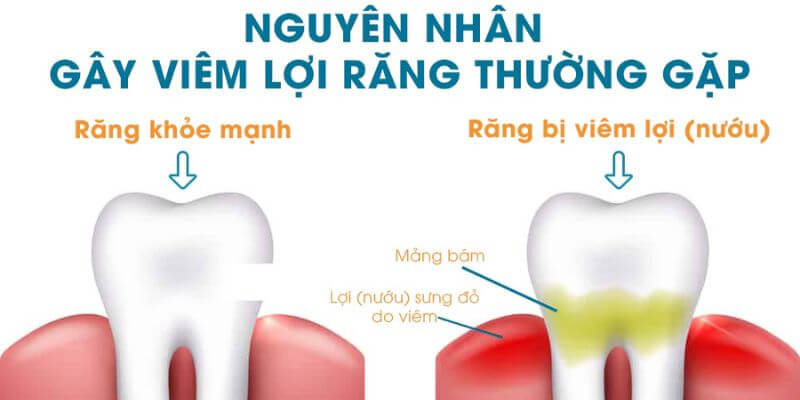 Mảng bám chứa vi khuẩn gây viêm lợi