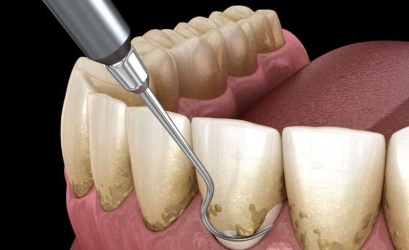Không chú ý đến chế độ ăn uống, vệ sinh hoặc các thói quen sinh hoạt hàng ngày sau khi cạo vôi khiến răng rất dễ tái bám mảng bẩn