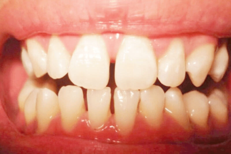Sau khi loại bỏ mảng bám khoảng trống dưới nướu tạo ra các kẽ hở