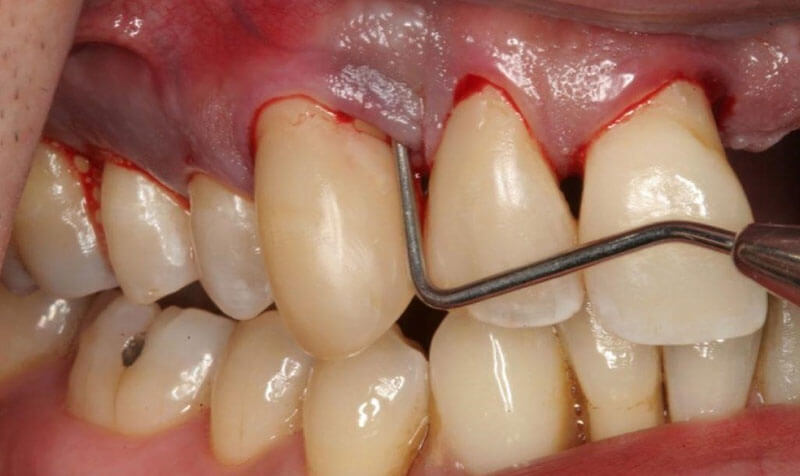 Lấy cao răng giúp ngăn ngừa các bệnh lý răng miệng nhưng thực hiện sai cách gây ra rủi ro nghiêm trọng